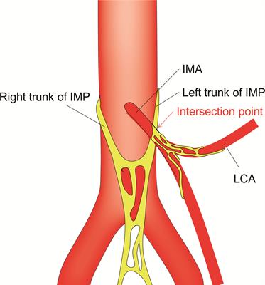 An Intrasheath Separation Technique for Nerve-Sparing High Ligation of the Inferior Mesenteric Artery in Colorectal Cancer Surgery